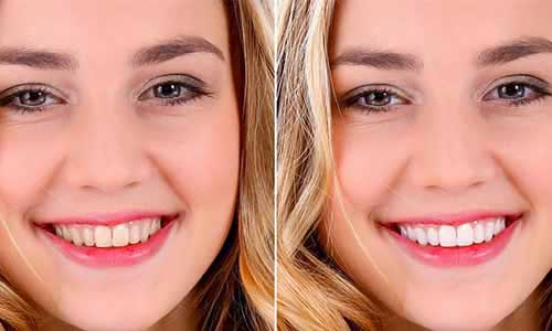 Teeth Whitening treatment at OM Dental Clinic